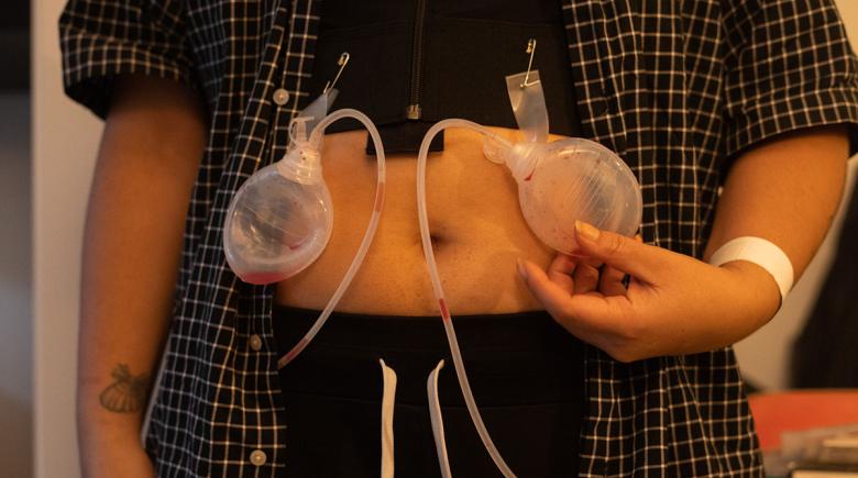 A photo of Chloe after their surgery. The photo shows their torso with a button down shirt opened up and their stomach exposed. Drains hang from their chest.